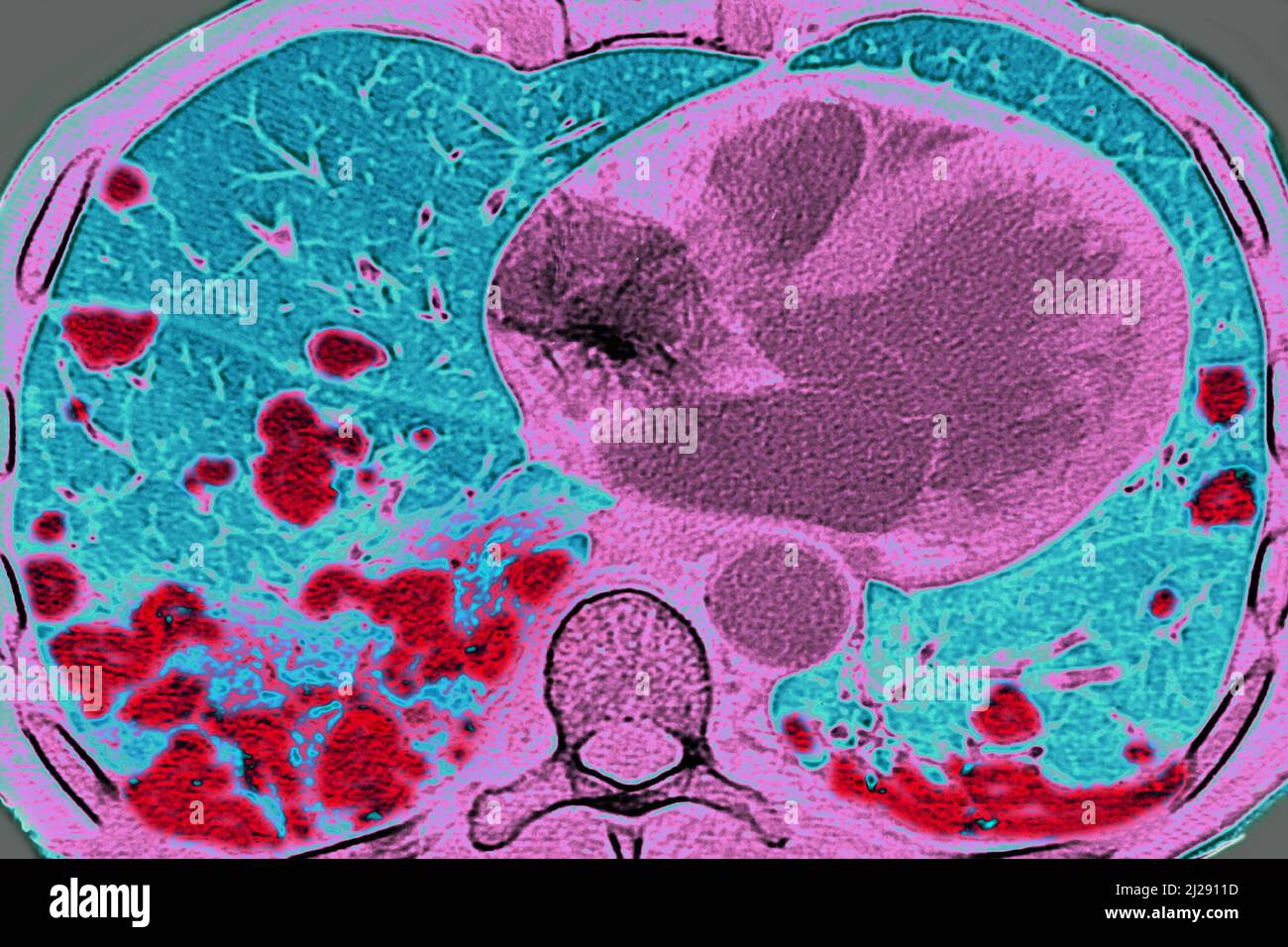 Lung metastases Stock Photo