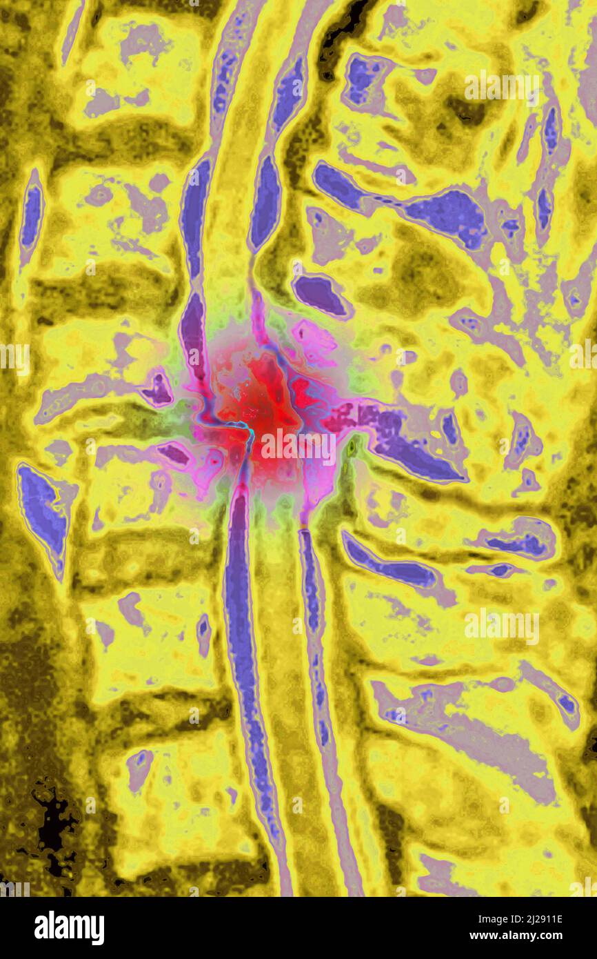 Cervical spine mri hi-res stock photography and images - Alamy