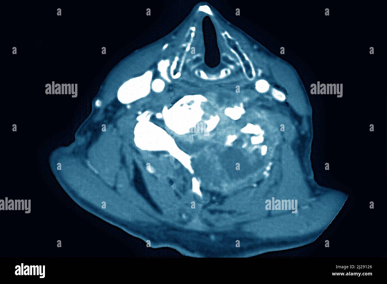 Malignant tumor localized on cervical vertebrae Stock Photo