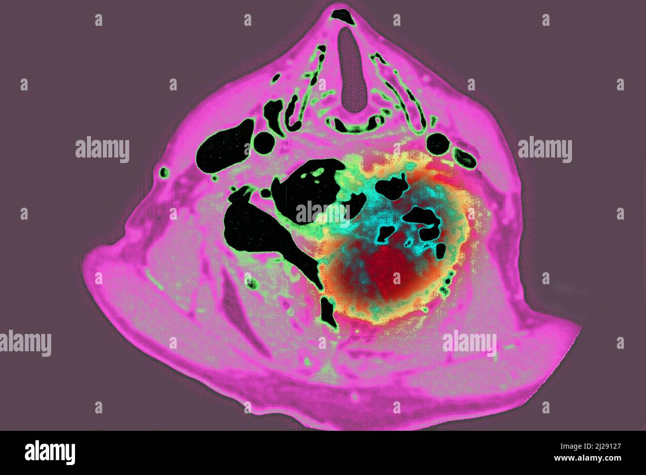 Malignant tumor localized on cervical vertebrae Stock Photo