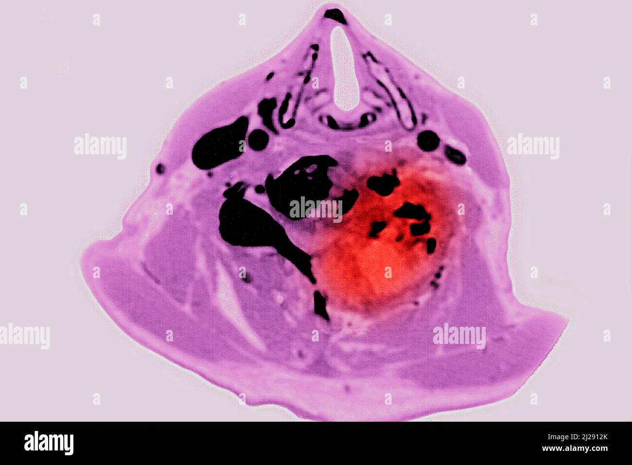 Malignant tumor localized on cervical vertebrae Stock Photo