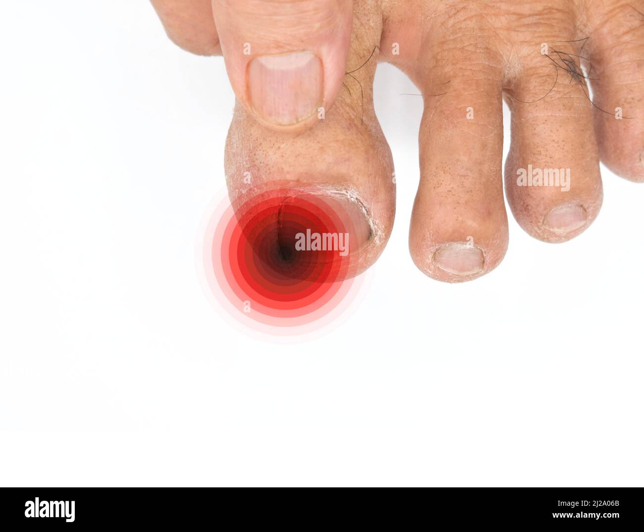Inflammation at the tip of toenail. Concept of paronychia at big toe of  Asian old man. Painful toe Stock Photo - Alamy