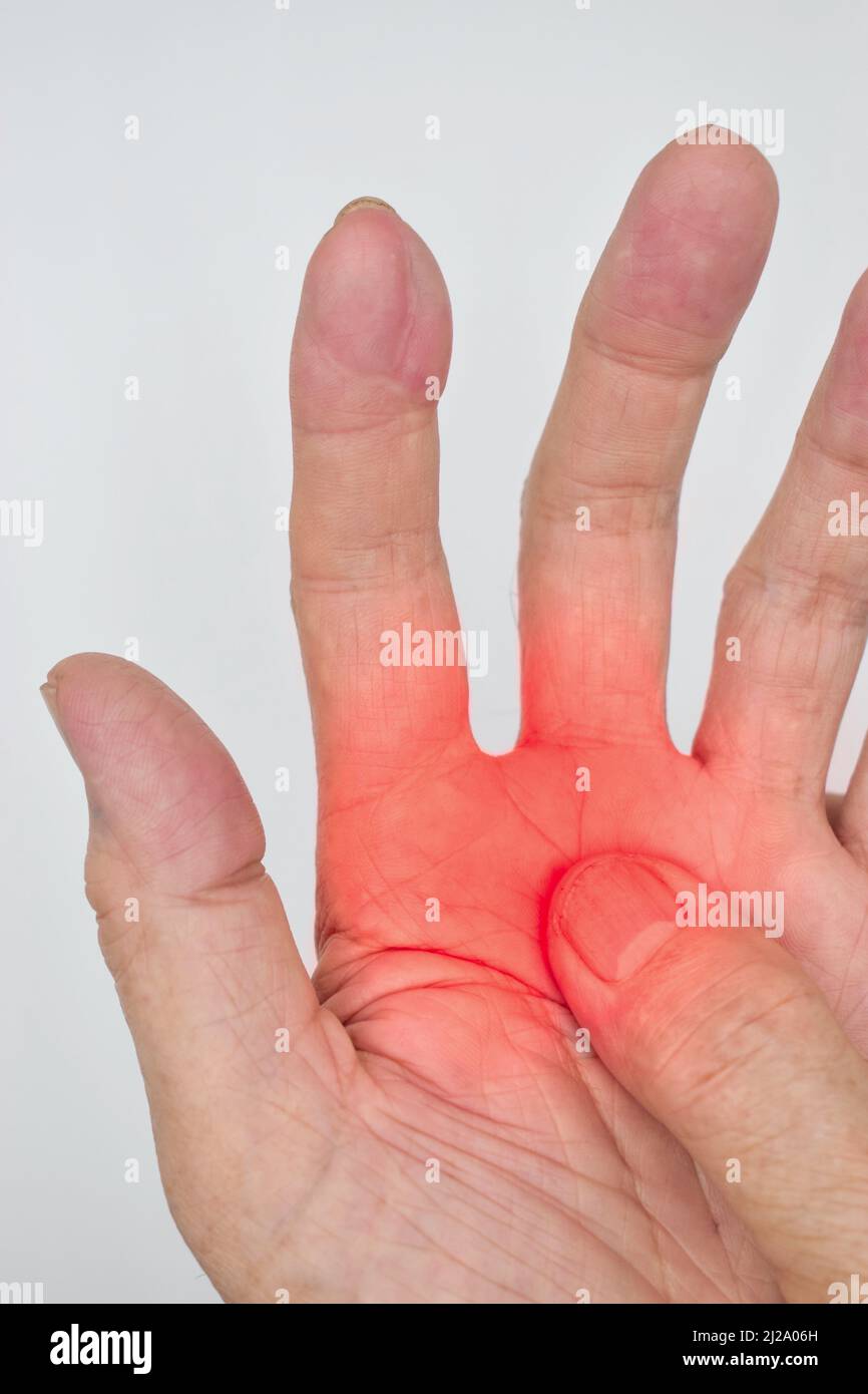 Painful palmar aspect of Asian old man. Concept of compartment syndrome, cellulitis and hand muscles pain. Stock Photo