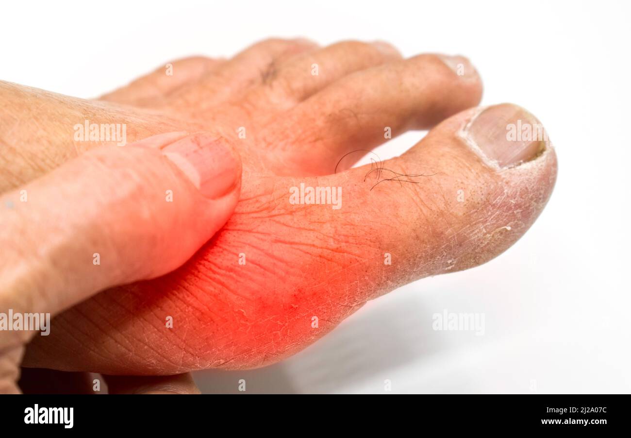 Inflammation of base of big toe. Concept of foot joint pain, arthritis, stumble, hyperuricema or gout. Stock Photo