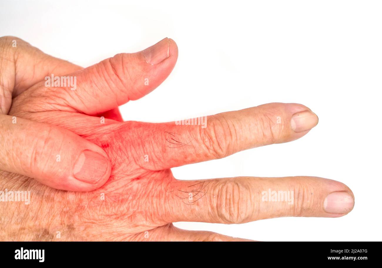 Painful dorsal aspect of Asian old man. Concept of tendonitis and hand muscles pain. Stock Photo