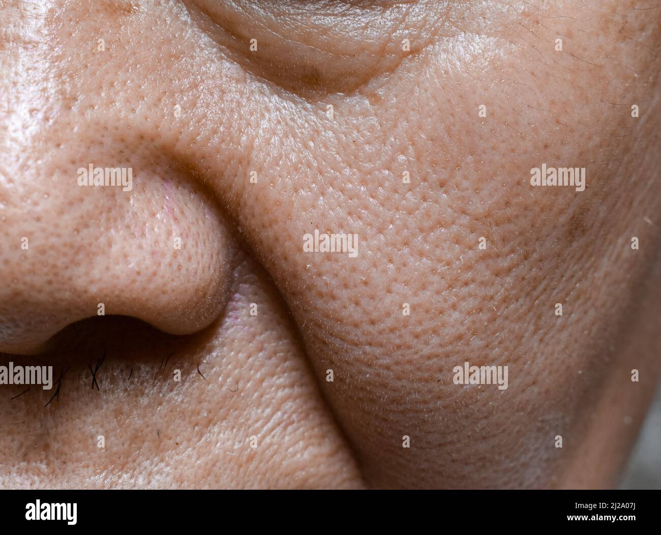 Enlarged pores in face of Southeast Asian, Chinese elder man Stock Photo