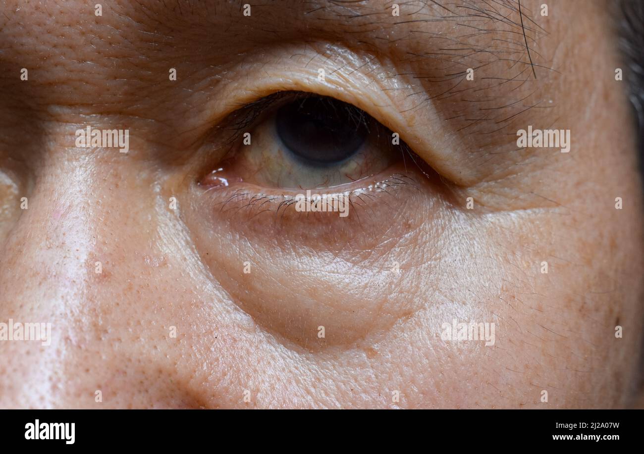 Prominent fat bag and wrinkles under eye of Asian elder man. Closeup view. Stock Photo