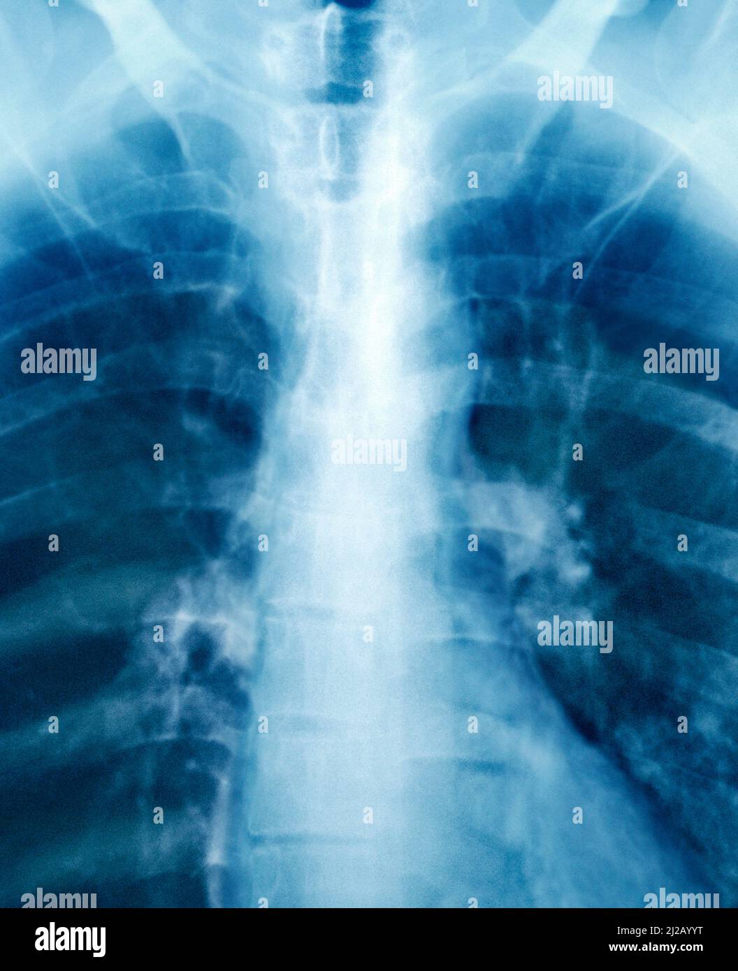 Human chest x-ray scan of adult female close-up or close up. Scientific diagnosis for disease. Stock Photo