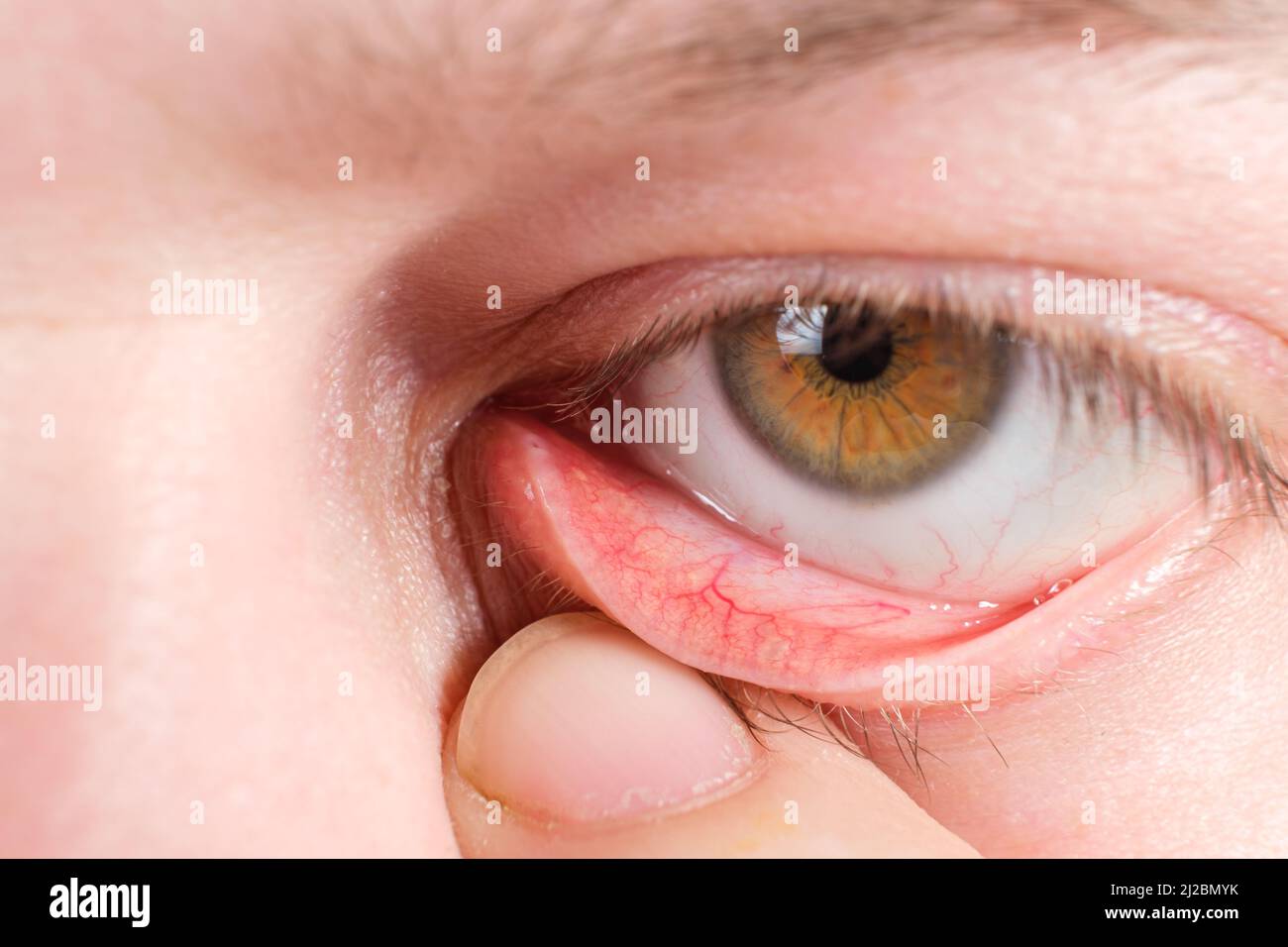 Red lower eyelid, a macro photo of the human eye. Conjunctivitis, inflammation of the mucous membrane of the eye. Stock Photo