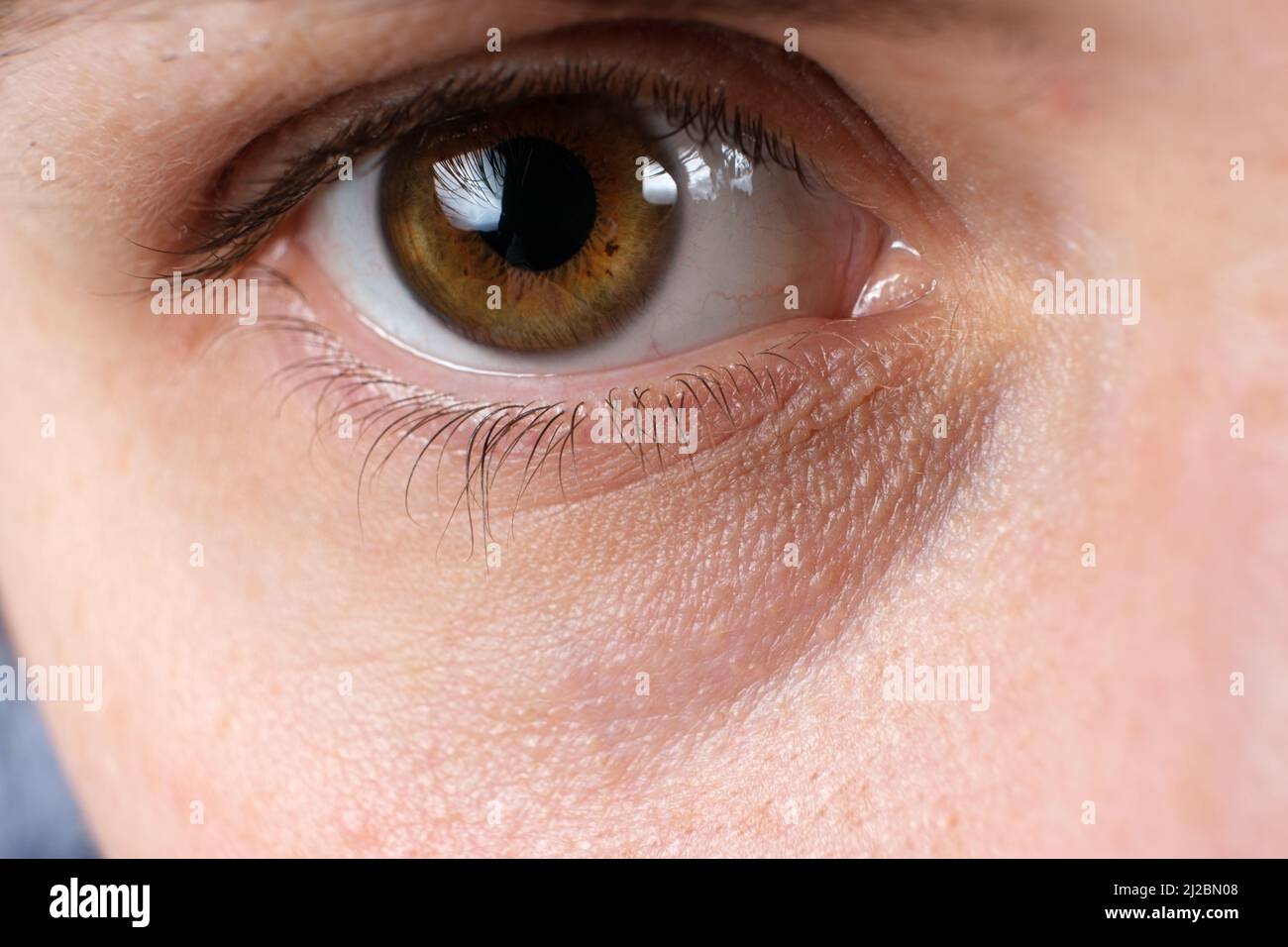 Swollen eye hires stock photography and images Alamy