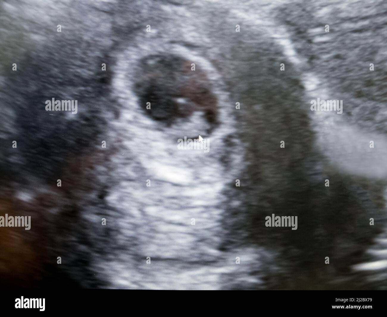 Obstetric Ultrasound of embryo at sixth week Stock Photo Alamy