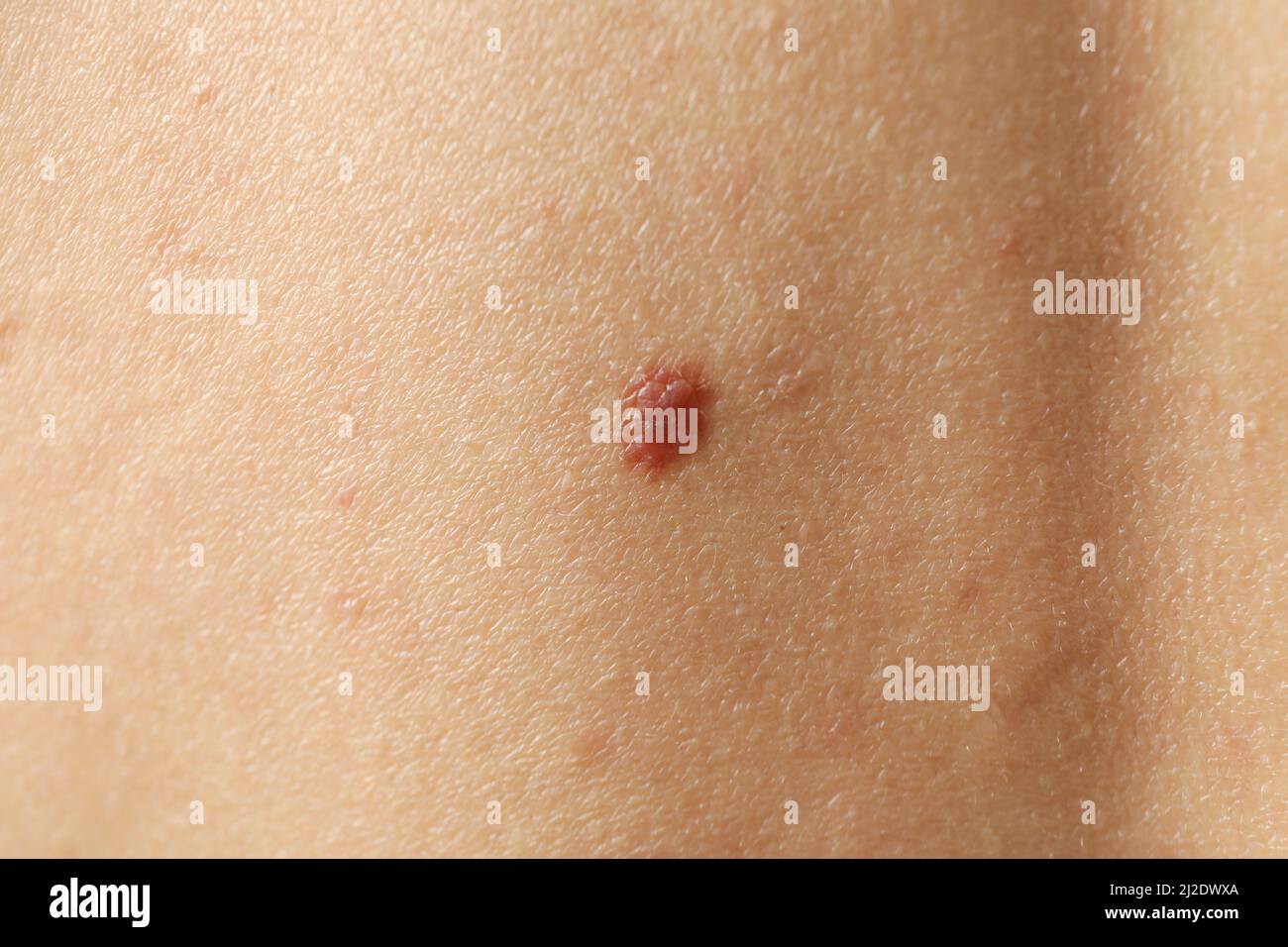 Concept of body care with skin with mole Stock Photo Alamy
