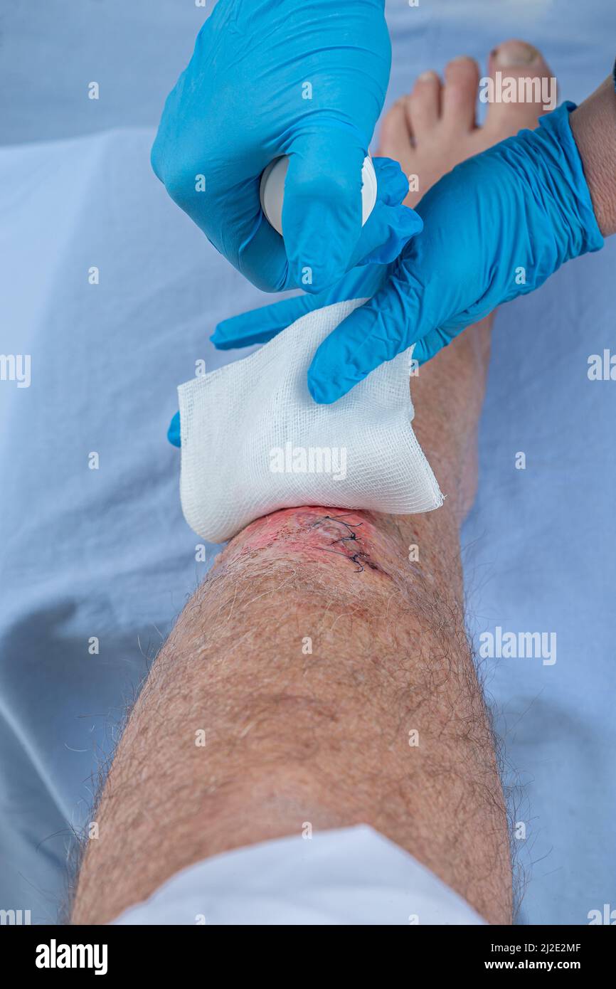 Nurse caring fresh blooded injury wound on the tibial bone of the leg. sticking stitches to hold the cut. Stock Photo