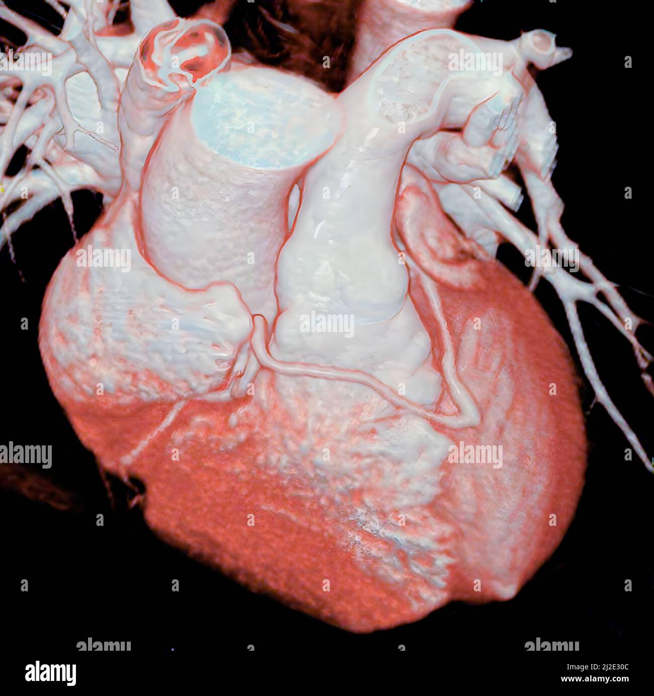 Congenital anomaly, coronary Stock Photo