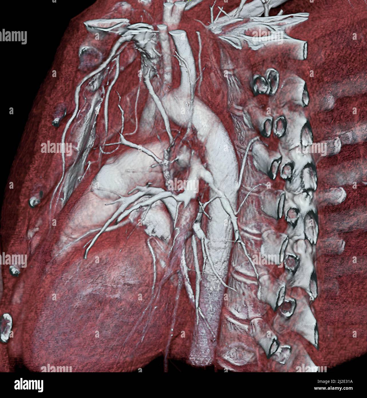 Arterial stenosis, 3d scan Stock Photo