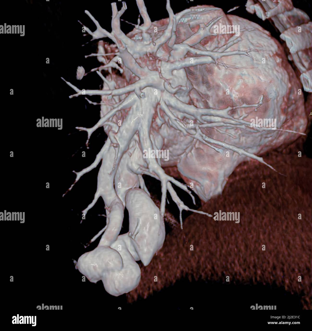 Arteriovenous fistula Stock Photo
