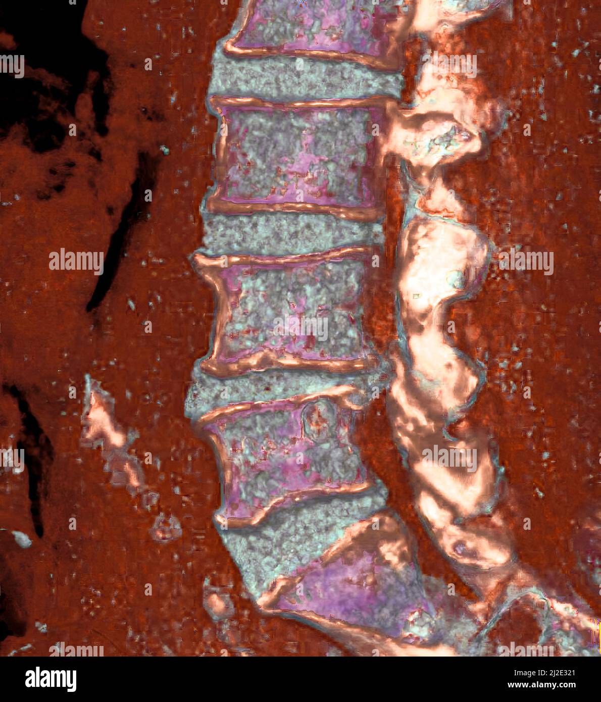 Herniated disk, 3d ct scan Stock Photo - Alamy