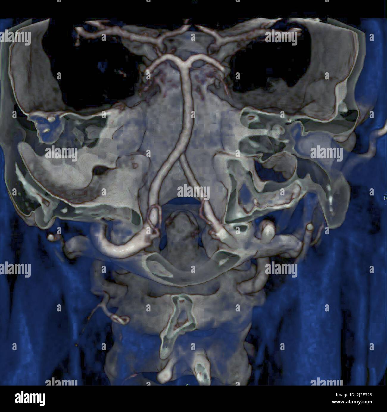 Cervical vertebra, scan Stock Photo