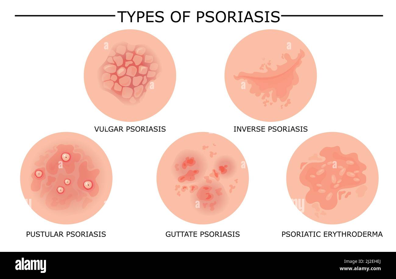 Different types of psoriasis vector set. Part of patients skin with dermatitis, inflammation, red rash and other skin problems. Cartoon illustration f Stock Vector