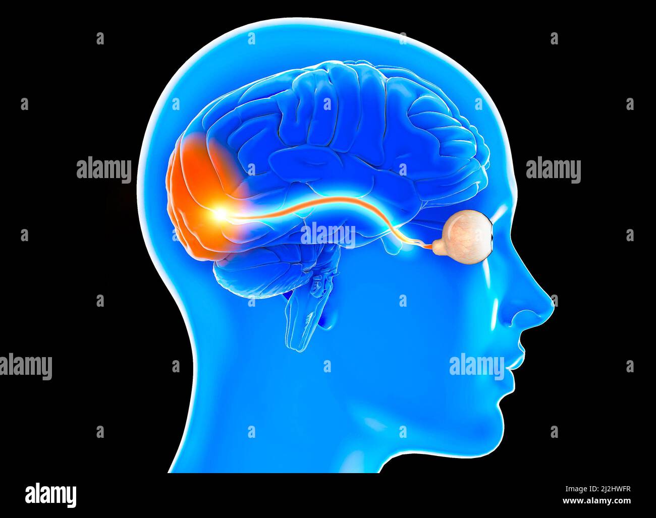 Optic nerve, section of the brain seen from the side. Nerve injury