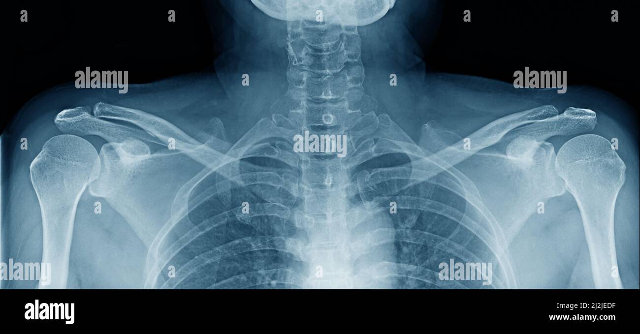 x-ray image of upper part of human body Stock Photo
