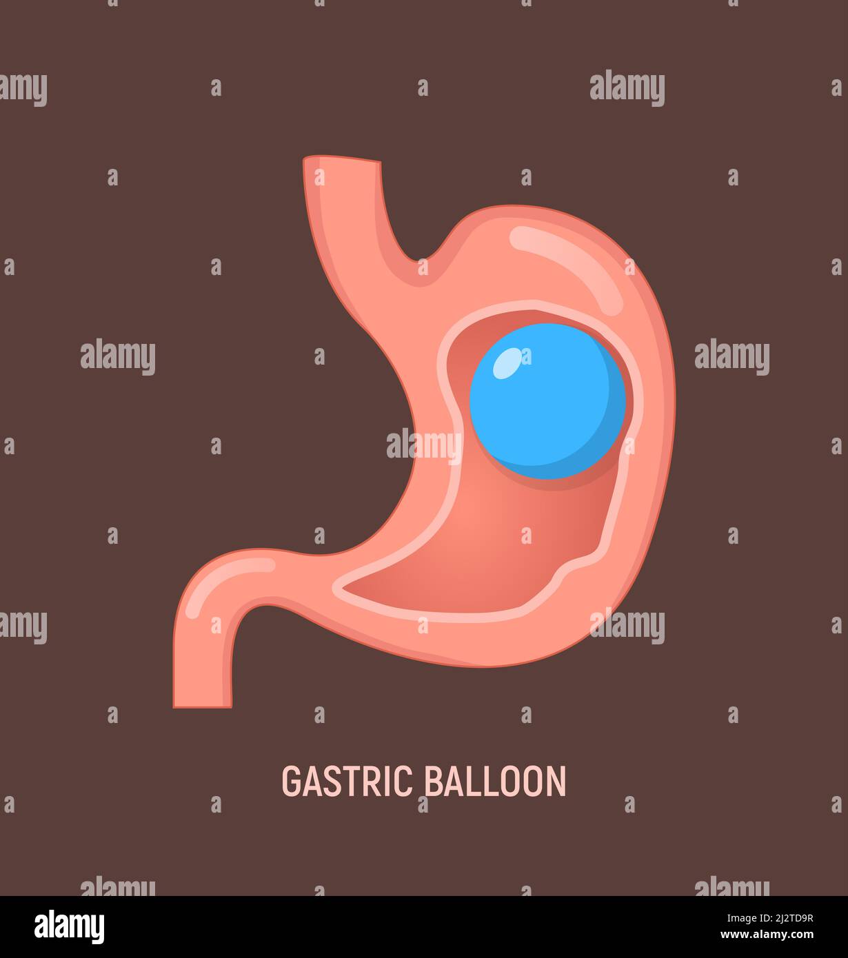 Gastric balloon weight loss intragastric surgery. Stomach gastric balloon operation vector icon Stock Vector