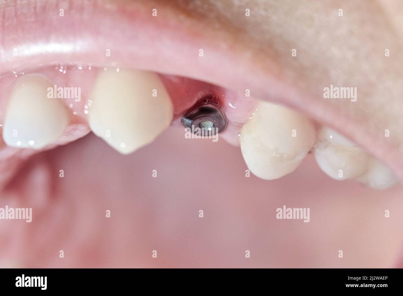 Real mouth with dental molar screw implant Stock Photo Alamy