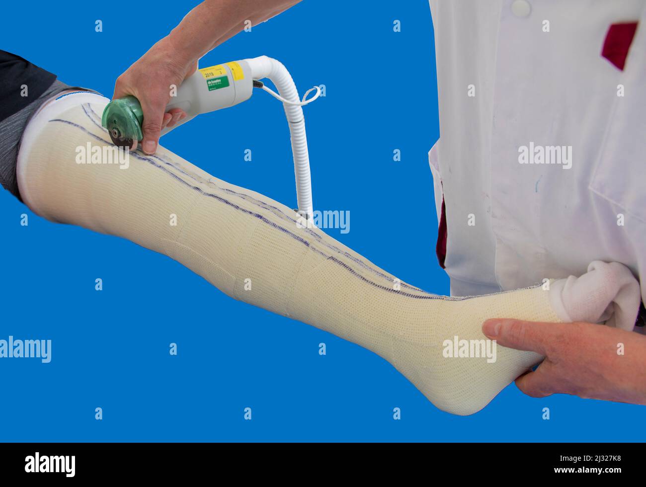Netherlands, the orthopedic cast from plaster is removed from a leg