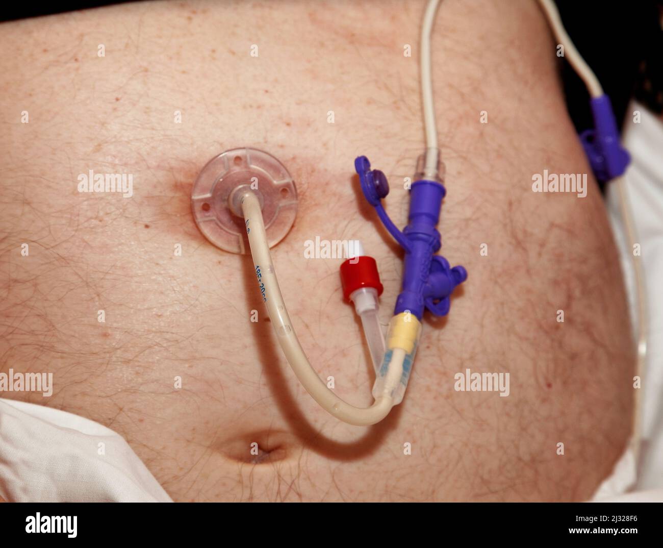 Percutaneous endoscopic gastrostomy (PEG) is an endoscopic medical procedure in which a tube (PEG tube) is passed into a patient's stomach through the Stock Photo