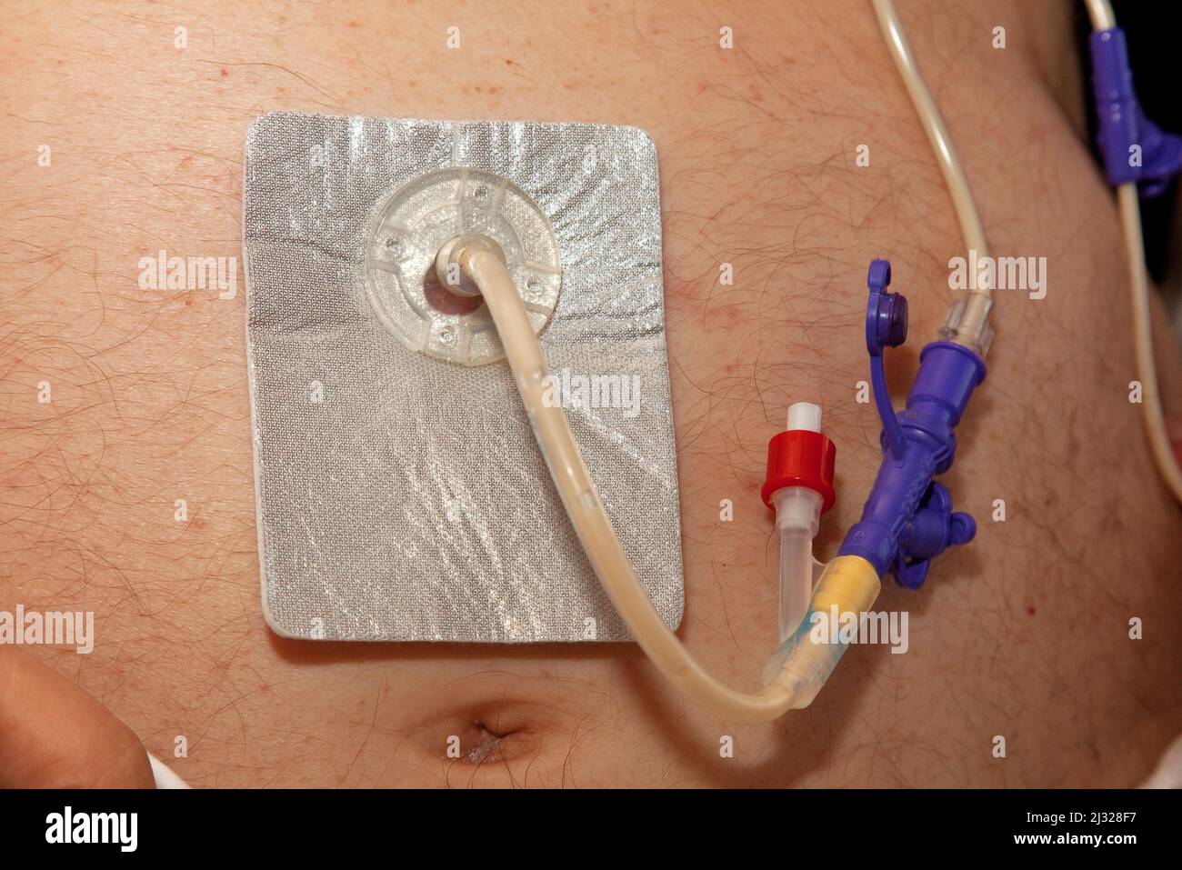Percutaneous endoscopic gastrostomy (PEG) is an endoscopic medical  procedure in which a tube (PEG tube) is passed into a patient's stomach  through the Stock Photo - Alamy