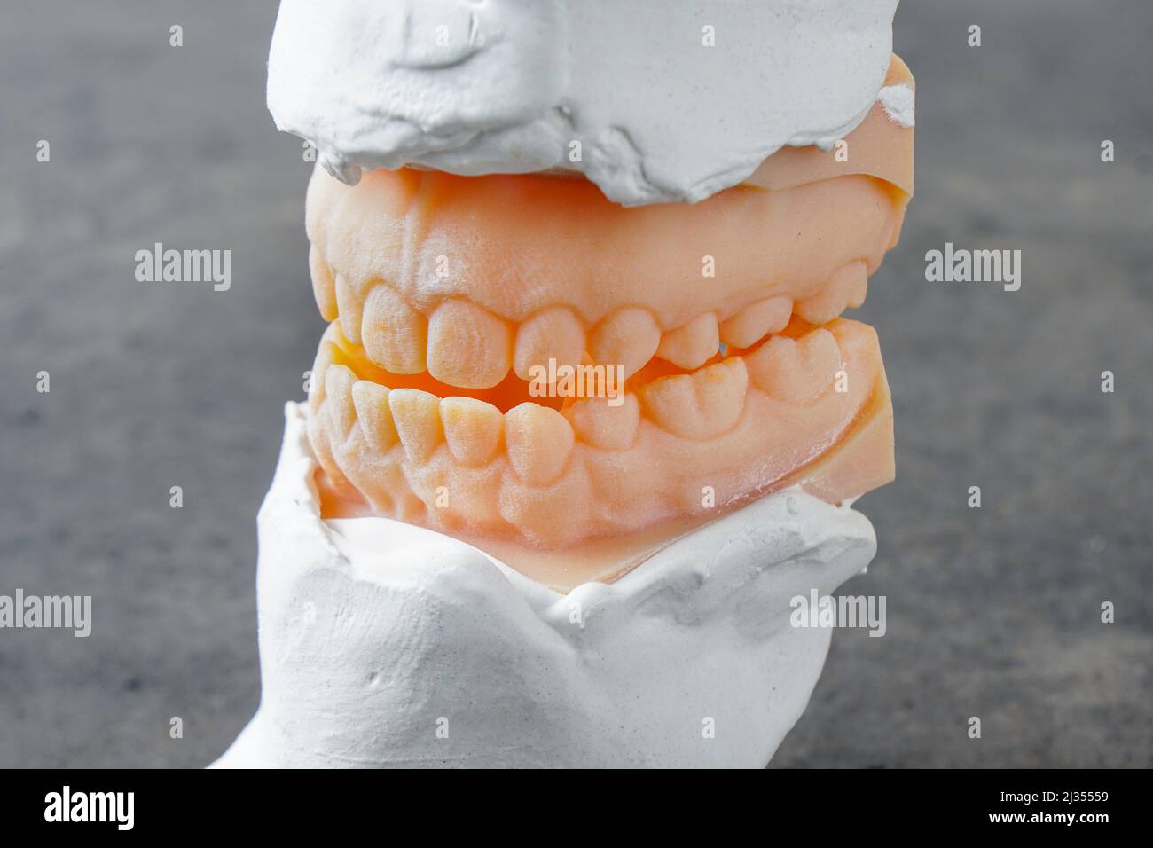 Underbite malocclusion teeth mold used for jaw surgery Stock Photo Alamy