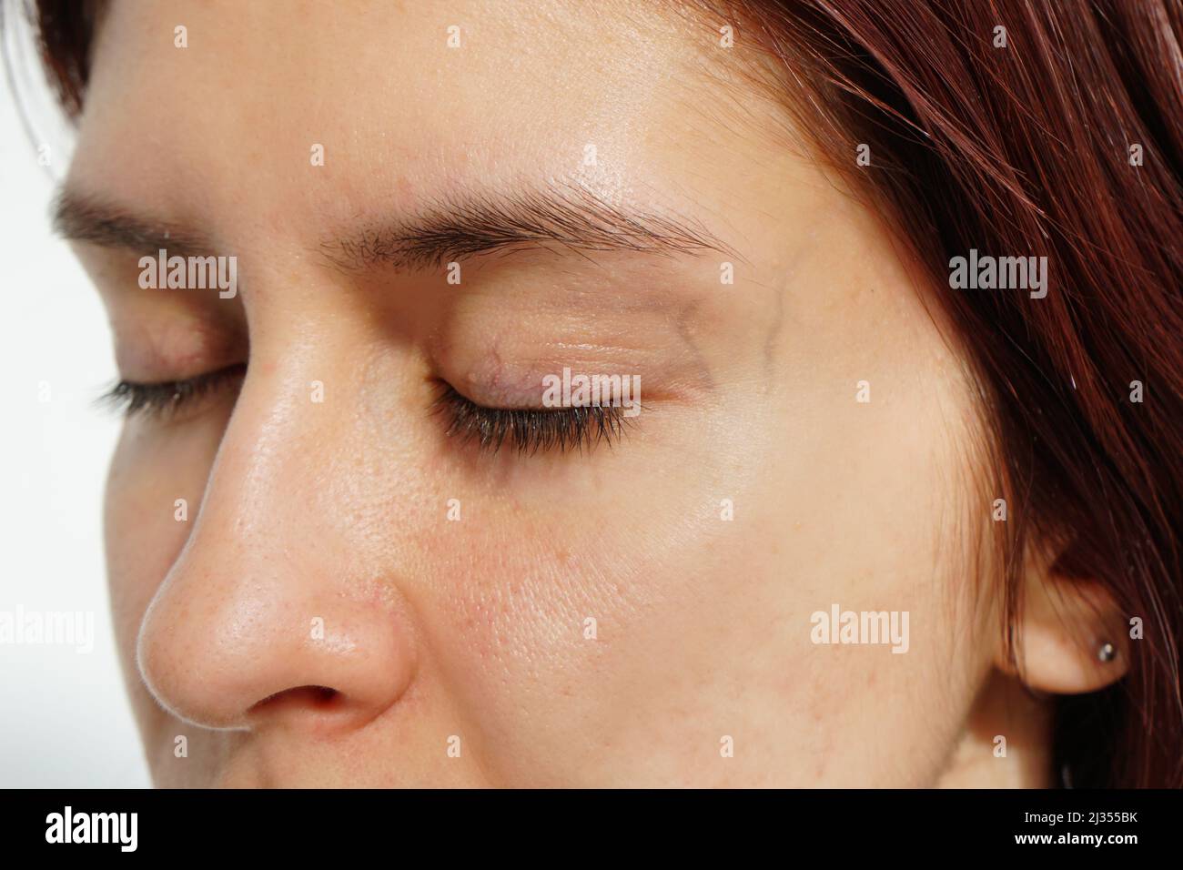 Woman before laser treatment with spider veins and broken capillaries around eyes. Stock Photo
