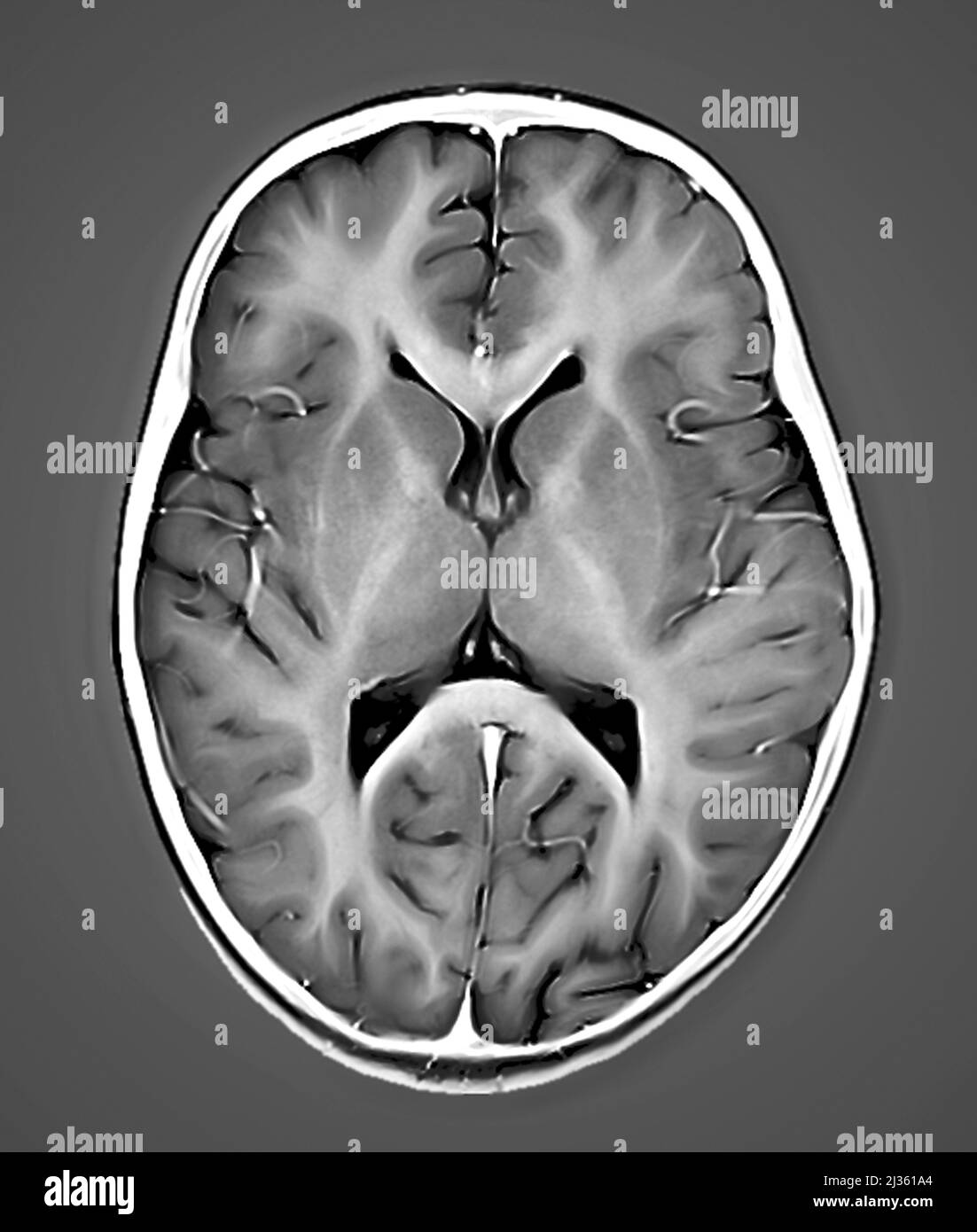 Healthy brain, MRI scan Stock Photo - Alamy