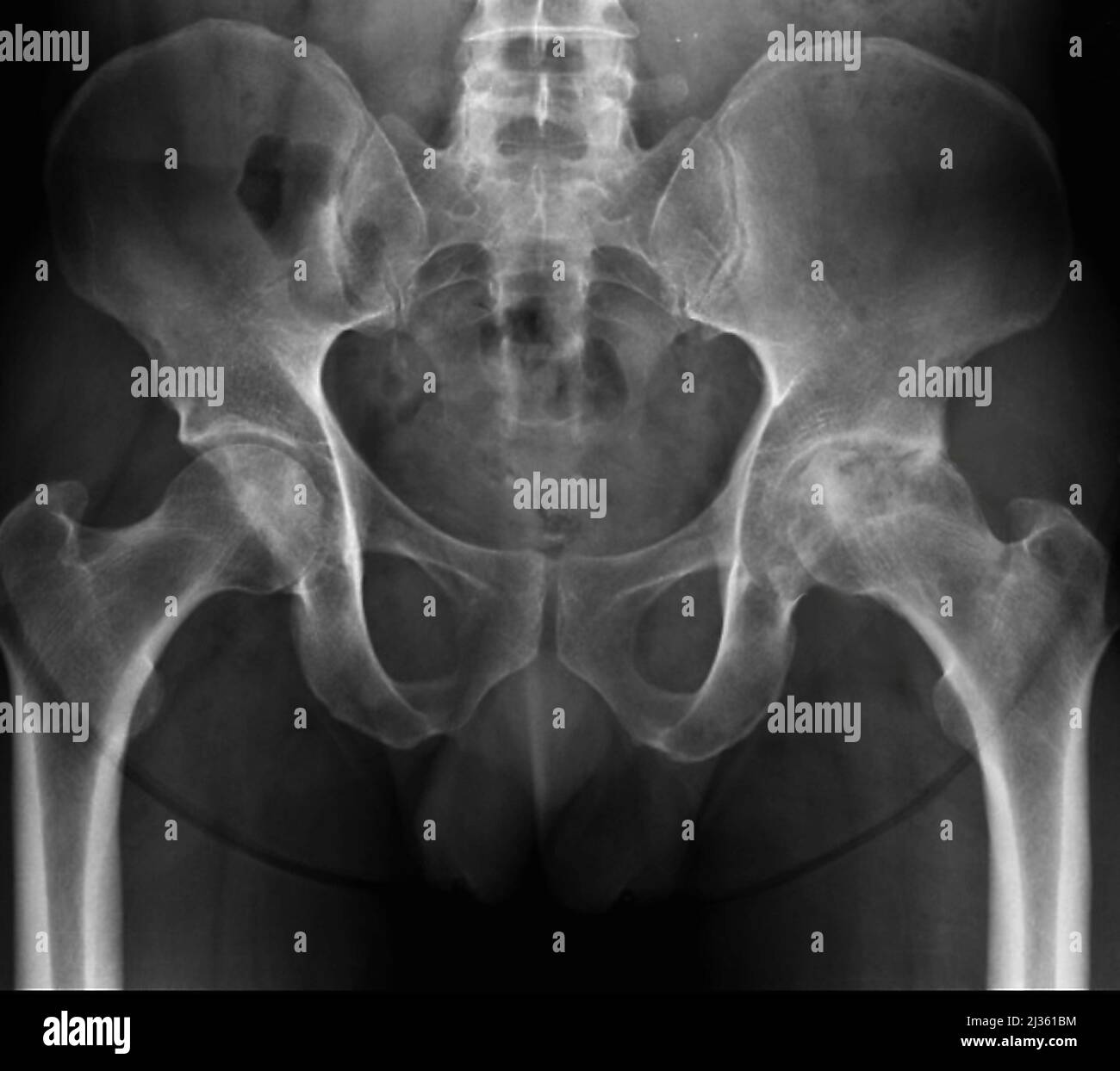 Osteonecrosis of the hips, X-ray Stock Photo - Alamy