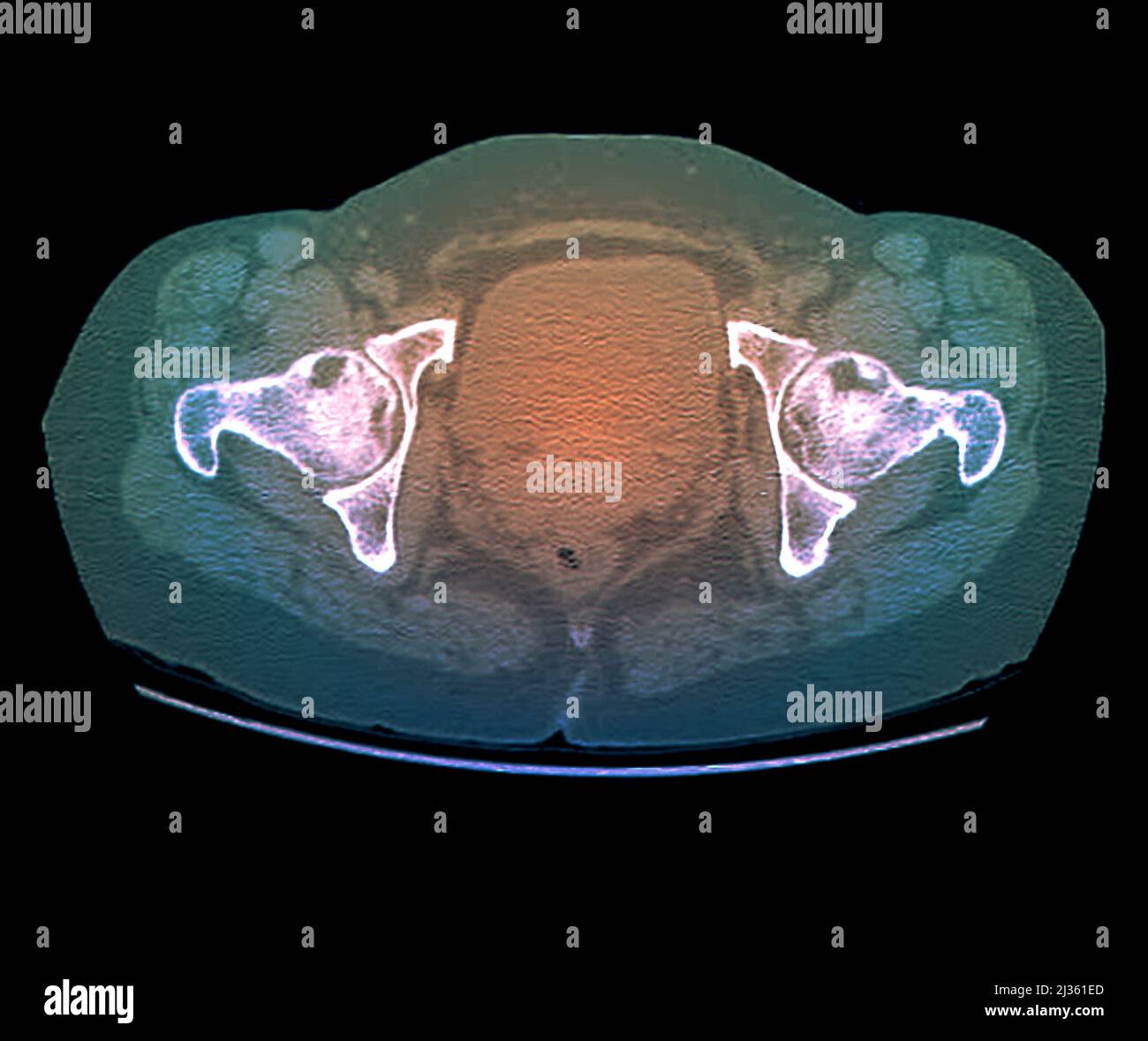 Osteonecrosis of the hips, CT scan Stock Photo - Alamy