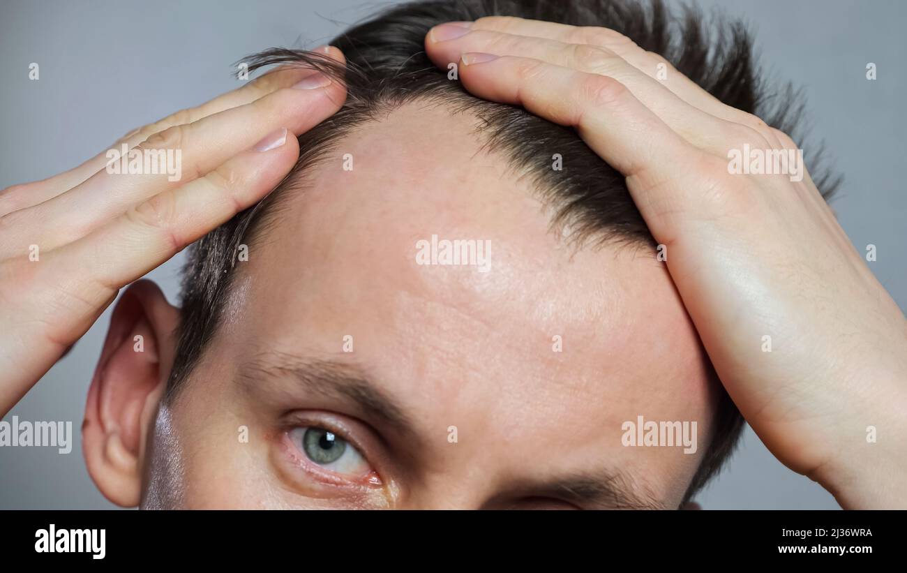Young man with bald spots suffering from hair loss Stock Photo - Alamy Young man with bald spots suffering from hair loss Stock Photo - Alamy
