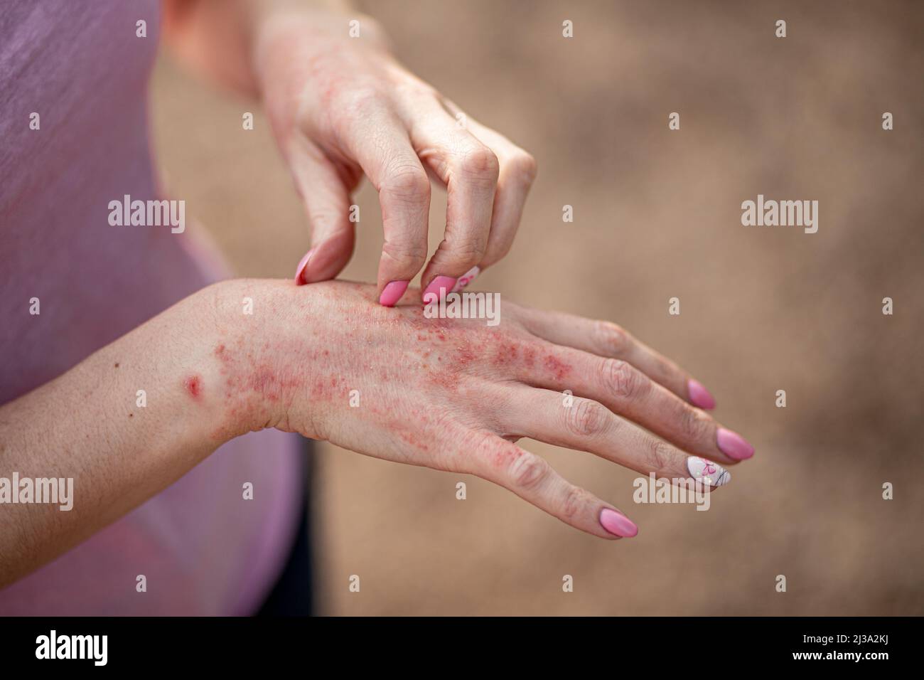 eczema dermatitis on hands and feet. red spots on the skin. dry skinThe concept dermatology, treatment fungal. woman scratching her hand. Stock Photo
