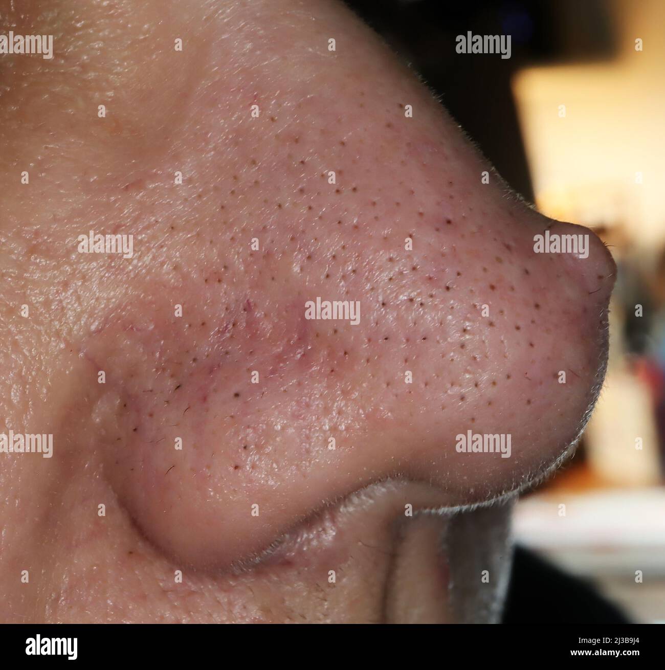 Facial wart hires stock photography and images Alamy