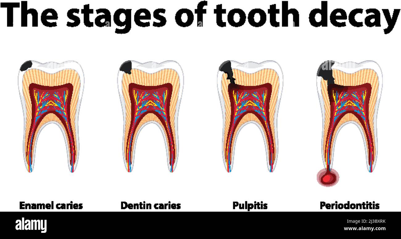 Tooth Decay Diagram
