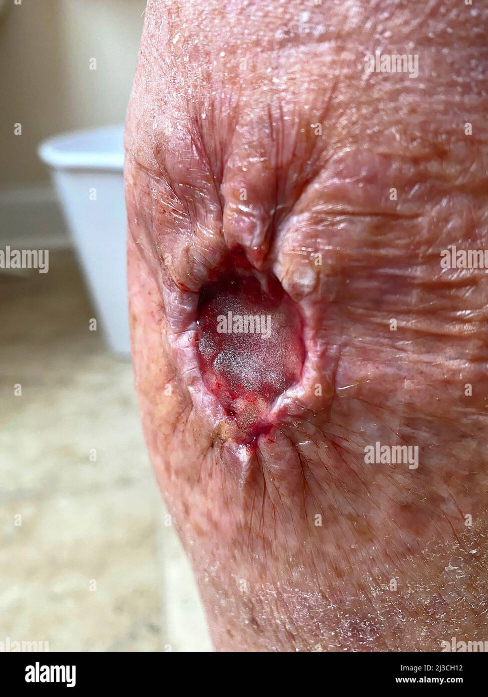open leg wound, after Mohs surgery, remove squamous cell carcinoma, purse string sutures, cavity, skin, sutures, medical, MR Stock Photo