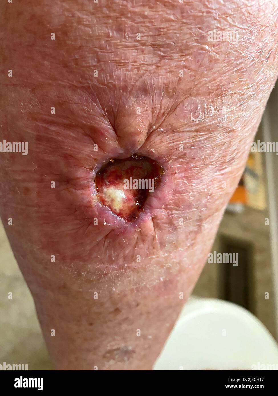 open leg wound, 2 weeks after Mohs surgery, remove squamous cell carcinoma, purse string sutures, cavity, skin, sutures, medical, MR Stock Photo