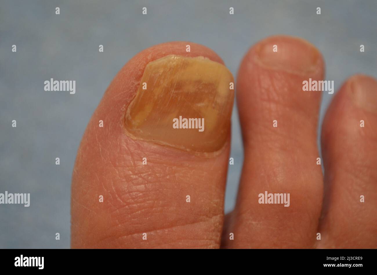 Cut toenail hires stock photography and images Alamy