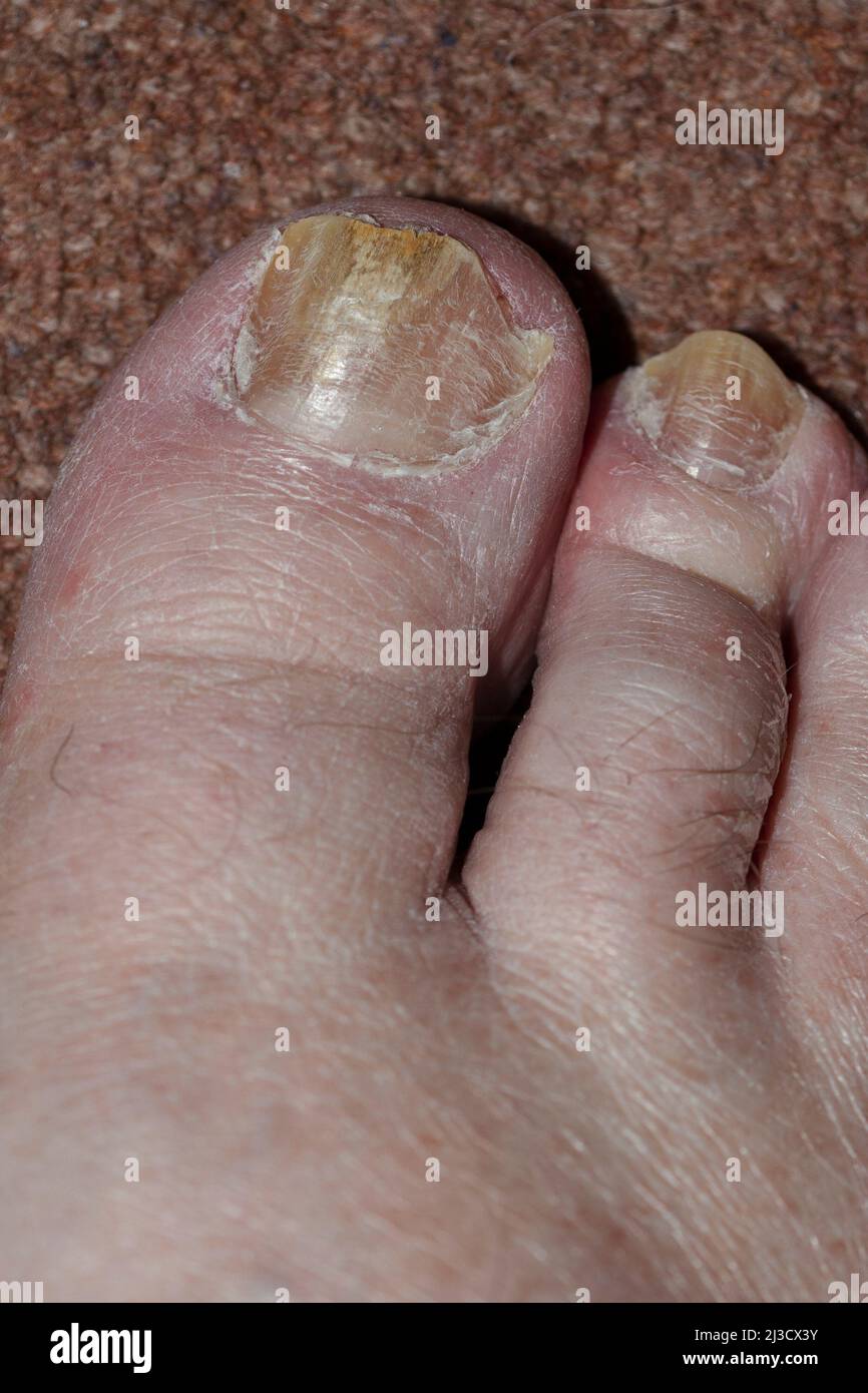 Fungal Nail Infection Stock Photo