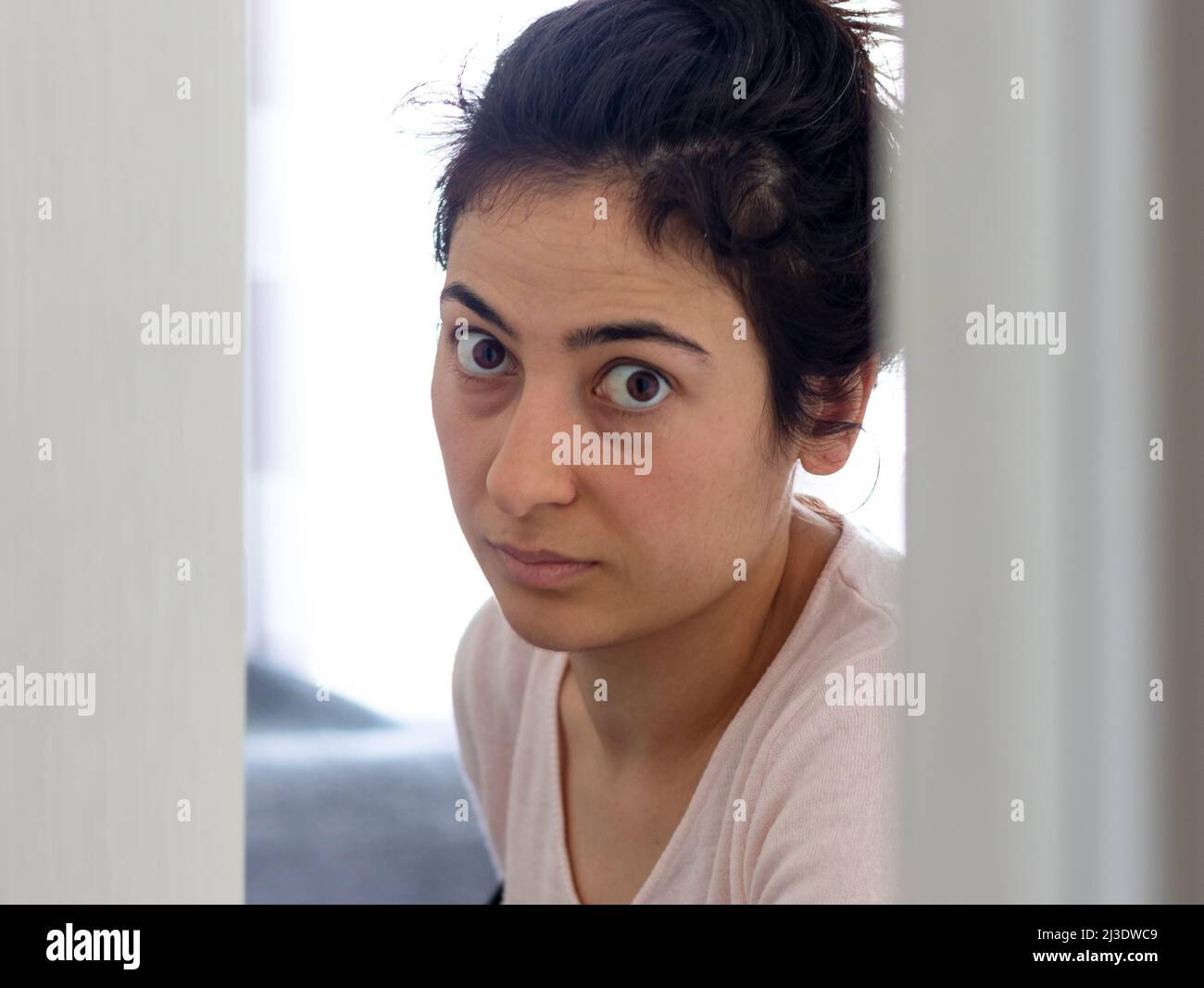 Close up photo of woman suffer from bulging eyes or orbital decompression. Stock Photo