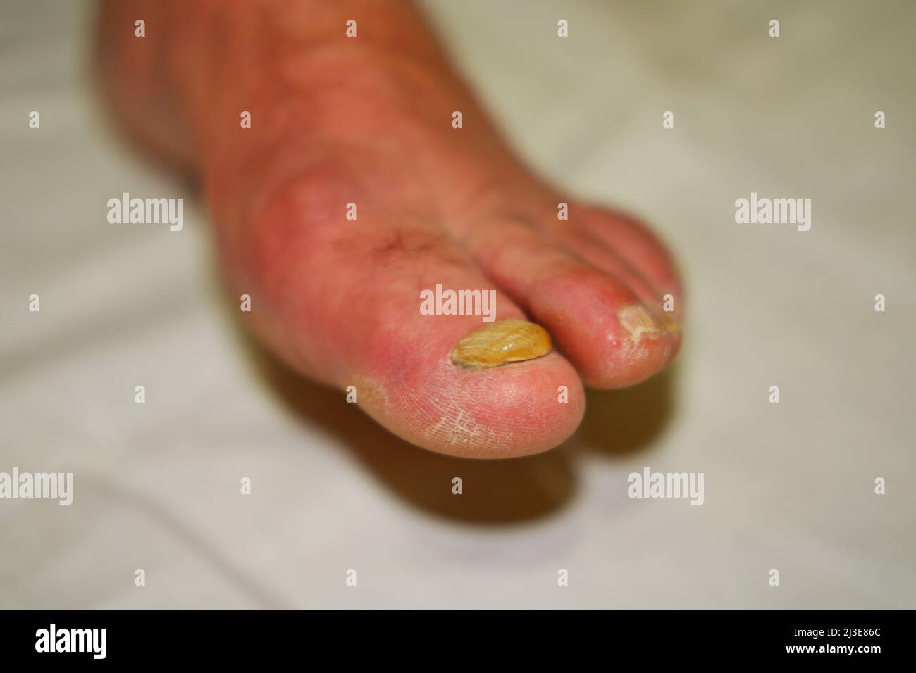 Toenails with fungal nail infection Stock Photo