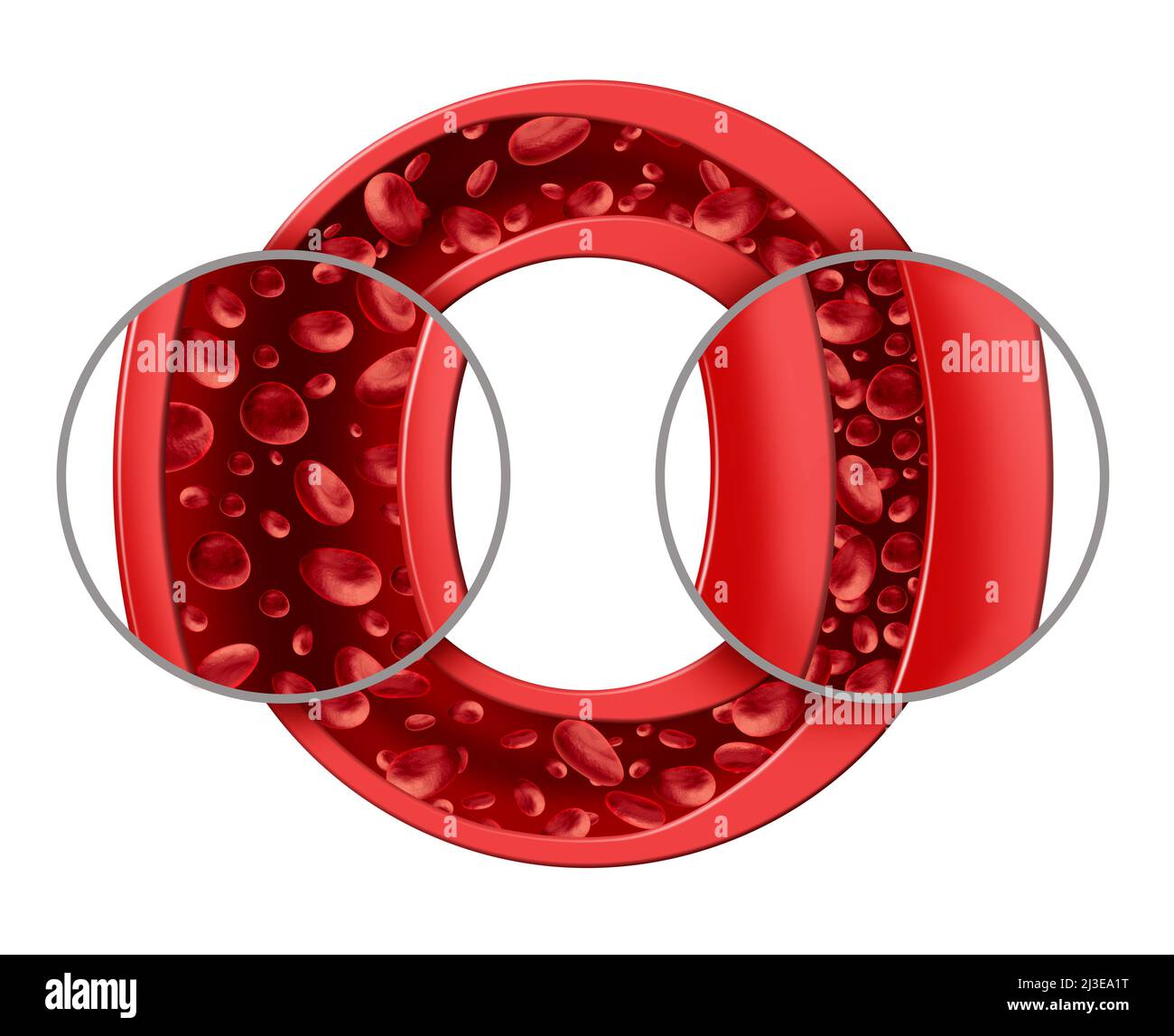 Hypertension And High Blood pressure as a medical diagram concept with a normal and abnormal hypertensive blood cell flow and human circulation. Stock Photo