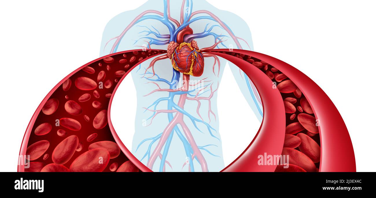Hypertension And High Blood pressure as a medical diagram concept with a normal and abnormal hypertensive blood cell flow and human circulation. Stock Photo