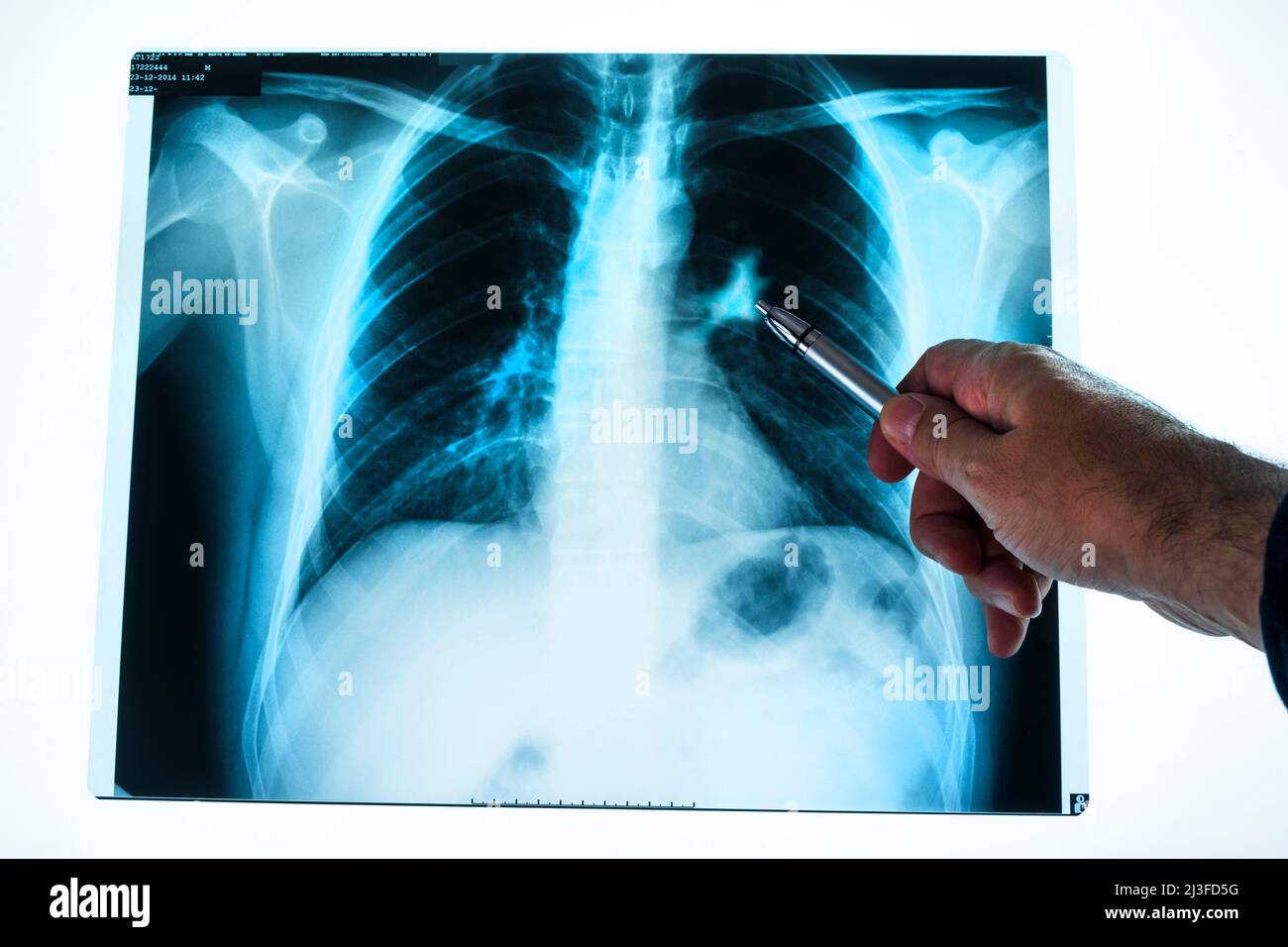 Human diseased Chest XRay Image, showing patient with fieldpen, health