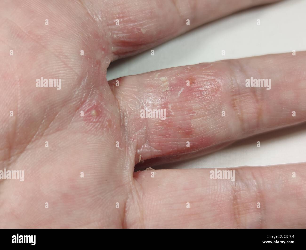 Hand eczema hires stock photography and images Alamy
