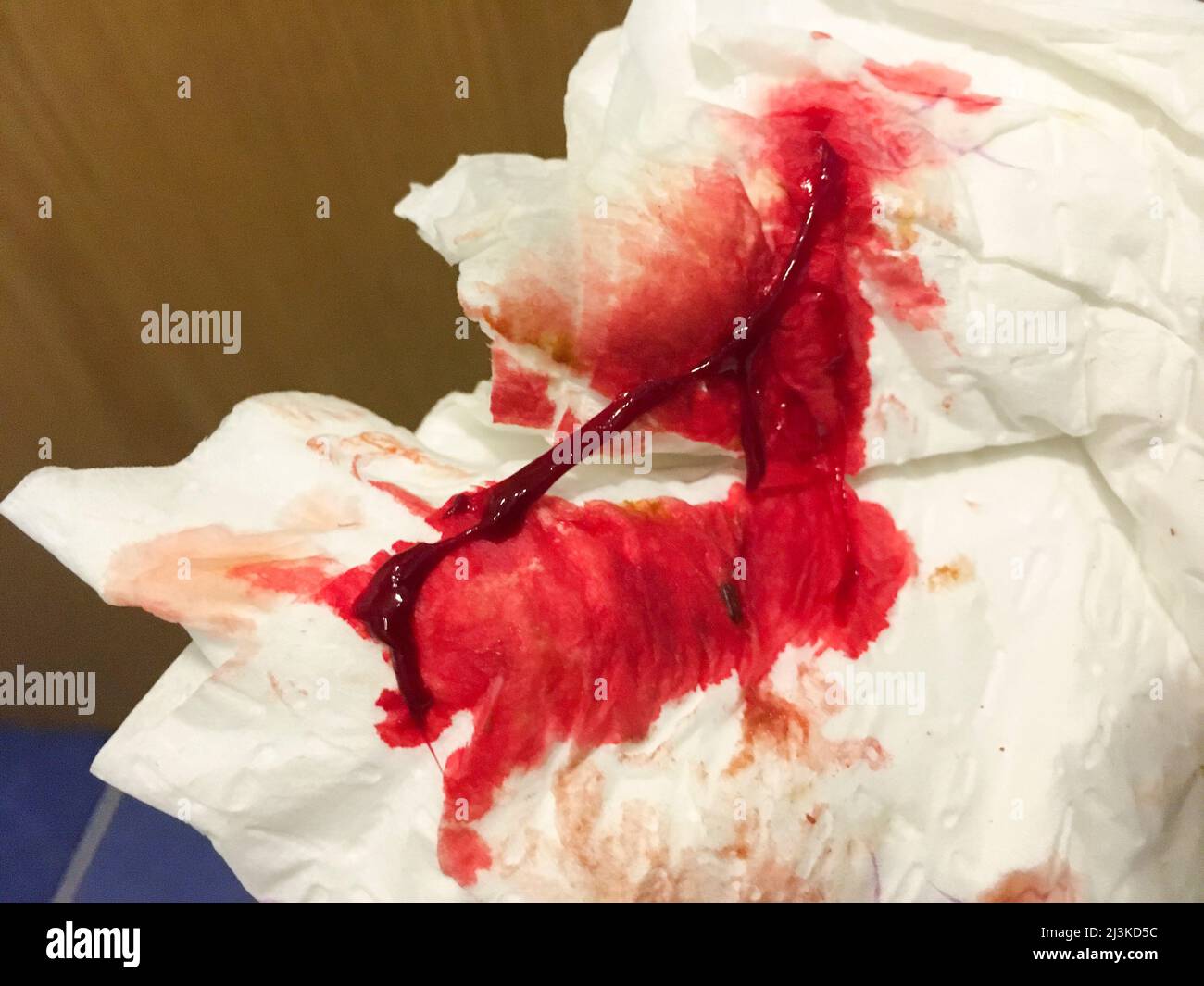 Blutung aus dem After auf dem Toilettenpapier Stock Photo